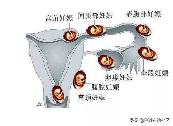 妇科精美解剖图片（异位妊娠）
