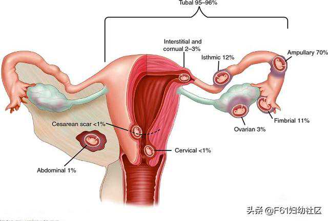 妇科精美解剖图片（异位妊娠）